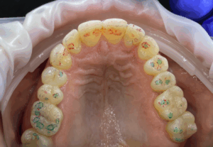 5 najczęstszych błędów w ocenie kontaktów zwarciowych – jak ich unikać? - blog stomatologiczny - artykuł o 5 najczęstszych błędów w ocenie kontaktów zwarciowych – jak ich unikać?